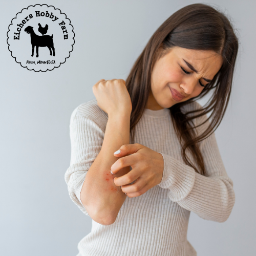 Understanding Psoriasis And The Benefits Of Goat Milk Soap Eichers